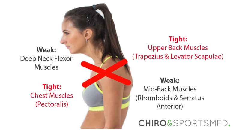 Upper Crossed Syndrome Ucs Chiro Sports Med